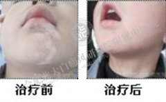 白斑的祛白成功，让孩子恢复以往童颜