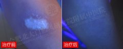 暴晒诱发白癜风，北大还女孩一个健康童年