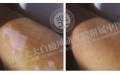 他把学生视作一切 可是自己却被白斑困扰着